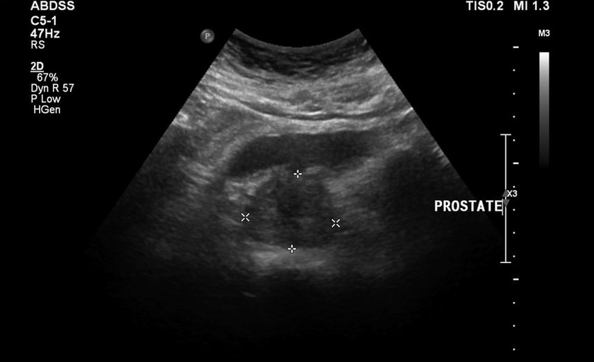 Ultrasound prostatitis before taking Urosaf