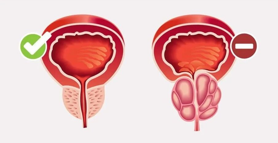 Male prostatitis