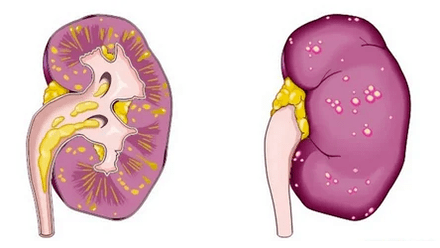 What is acute prostatitis causing