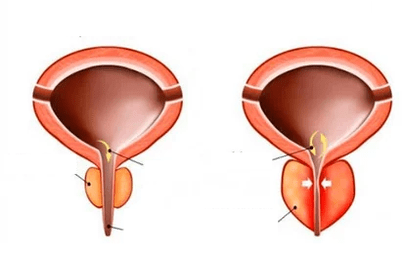 What is acute prostatitis