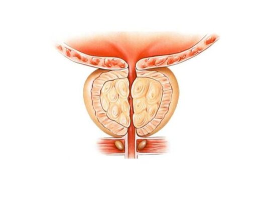Prostatitis increases prostate